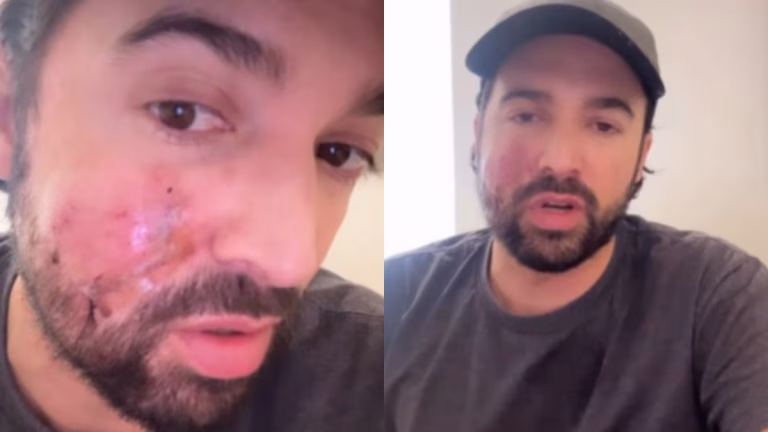 Actor Carlos Girón sufre ataque de perro y comparte su experiencia en redes