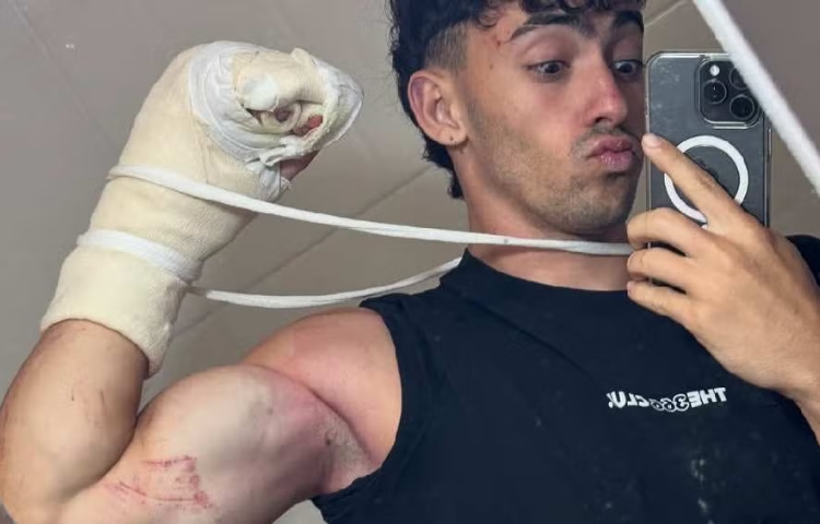 Influencer Gero Arias sufre caída de 10 metros y pierde dos dedos