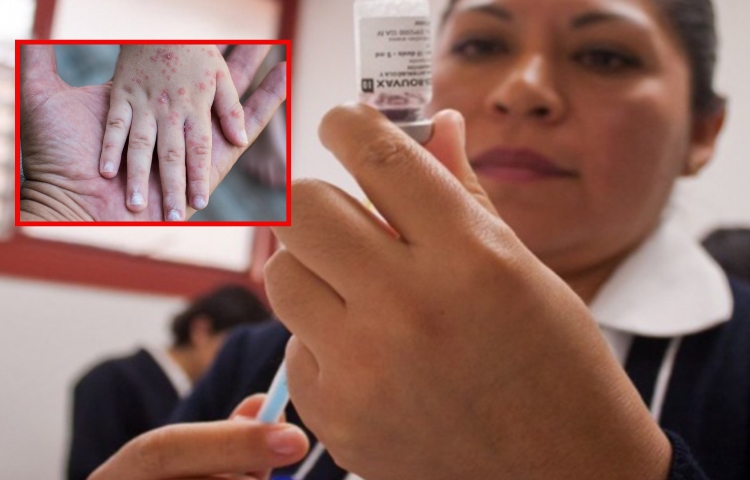 Alerta sanitaria en Casas, Tamaulipas autoridades intensifican acciones tras casos de sarampión