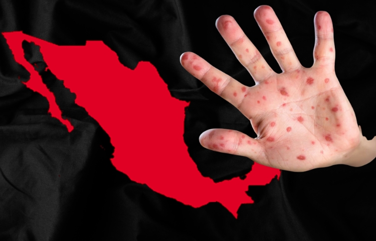 Sarampión en México: autoridades alertan sobre falta de vacunación