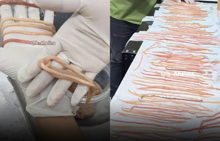 Extraen 142 lombrices del intestino de un niño en Chiapas