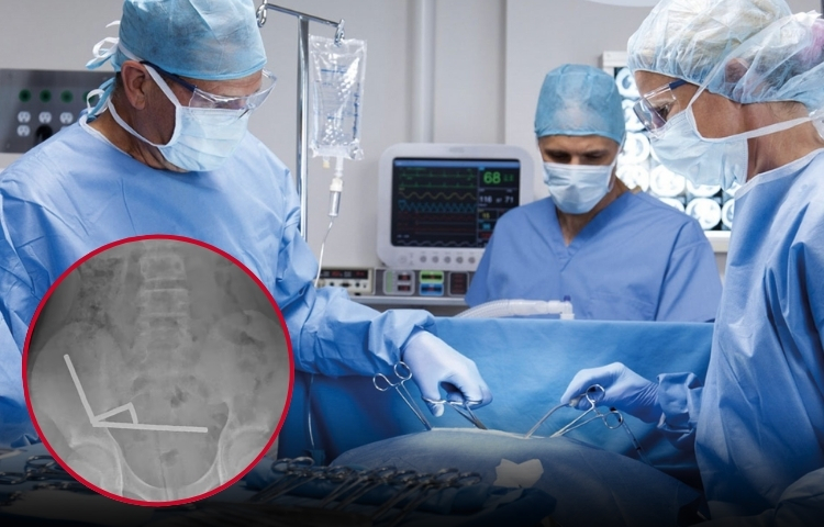 Adolescente de 13 años pierde parte del intestino tras ingerir más de 80 imanes de alta potencia